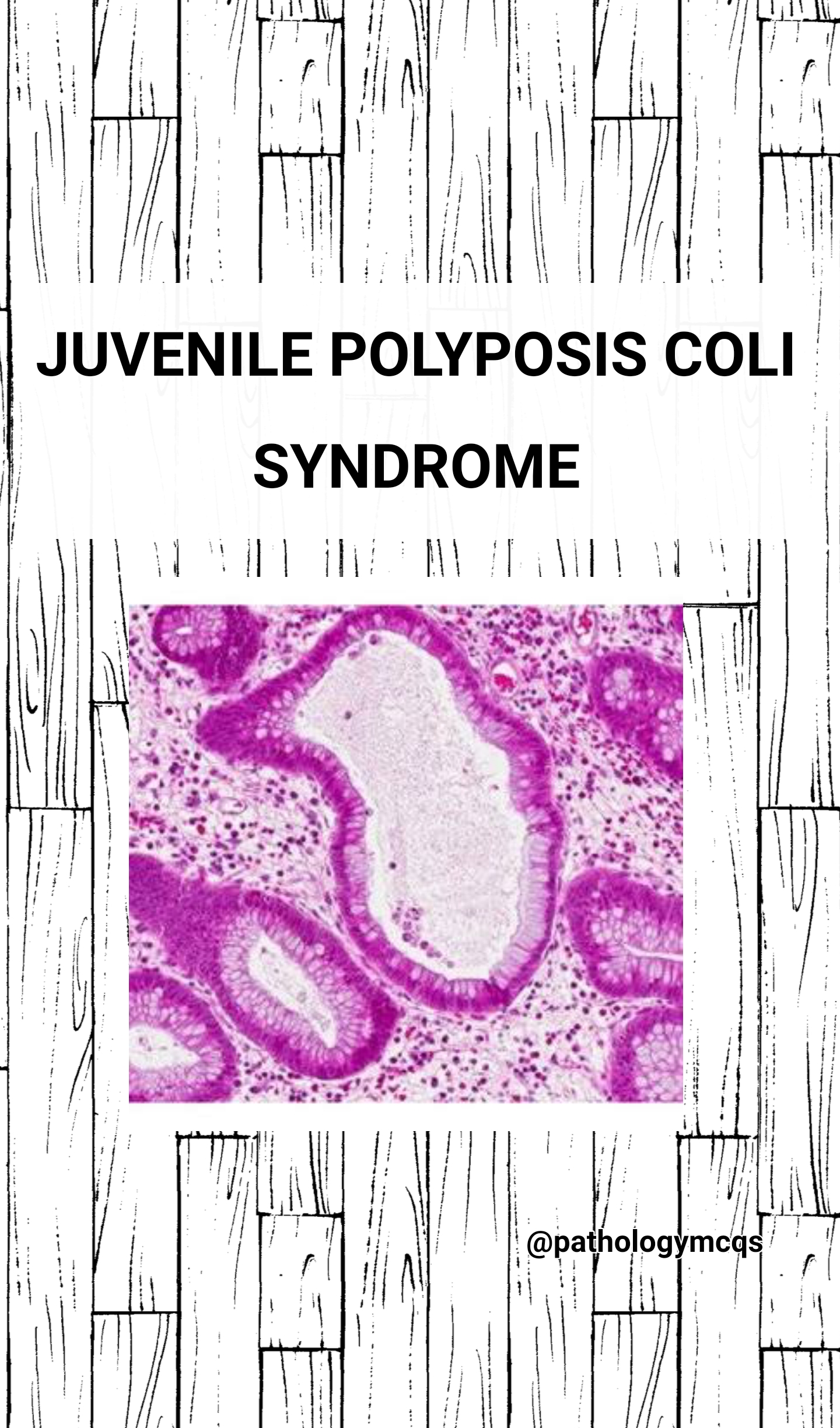 Juvenile POLYPOSIS coli syndrome