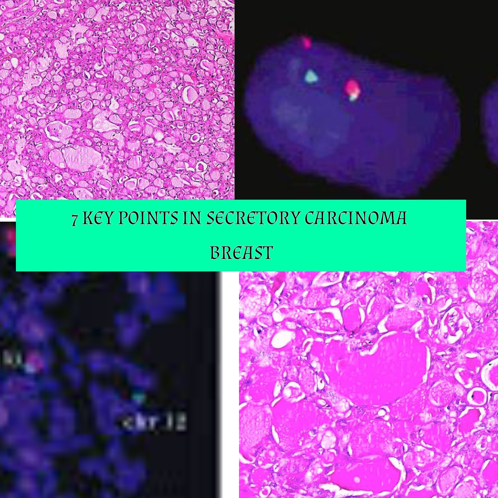 1.Presence of microcystic, solid or tubular pattern 2. PAS- Positive and diastase resistant 3. ETV-6 NTR3 t(12;15) is seen in these tumors 4. Common in children but can occur in all age groups 5. Often triple negative ( ER, PR and Her-2 negative) 6. Even though these tumors are triple negative- TP53 mutation is uncommon. 7. Lack gain of 1q and loss of 16q seen in low grade pathway