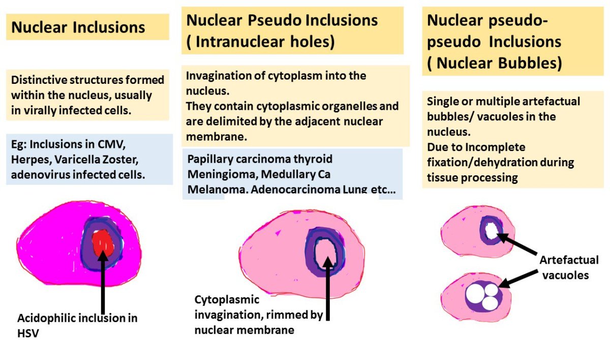 NUCLEAR INCLUSIONS AND PSEUDO-INCLUSIONS - PATHOLOGY MCQs