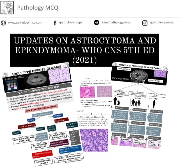 UPDATES FROM WHO CENTRAL NERVOUS SYSTEM 5TH EDITION- 2021- ASTROCYTOMA AND EPENDYMOMA