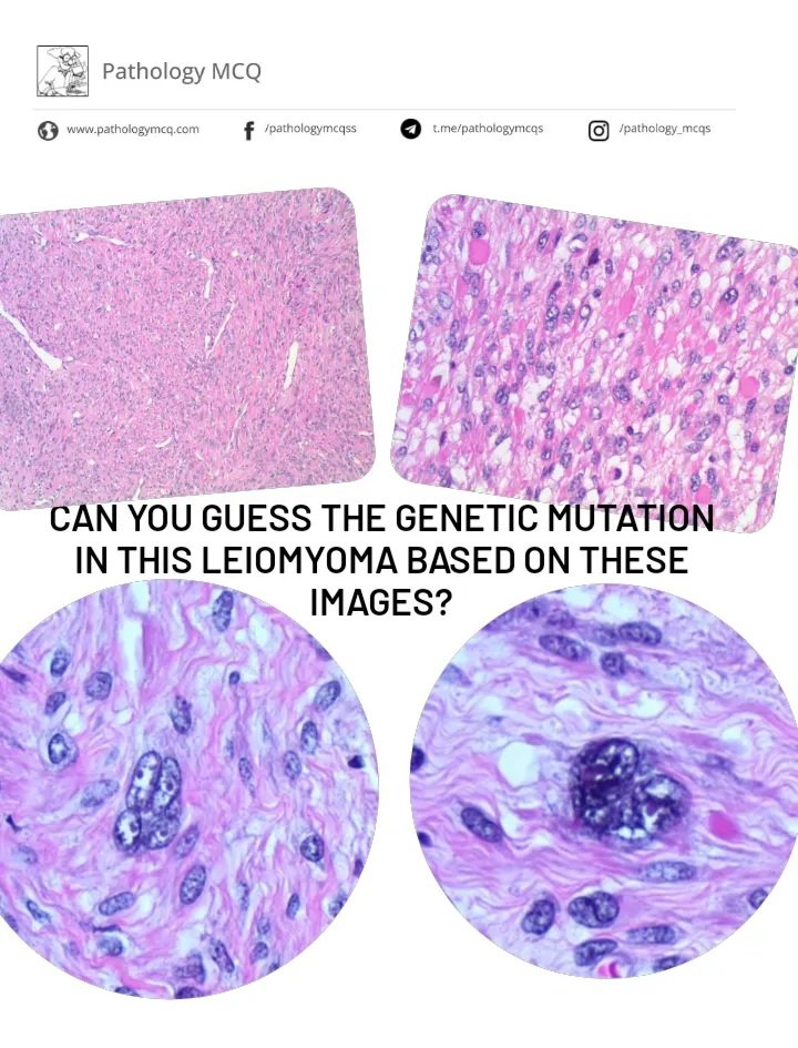 CAN YOU GUESS THE MUTATION IN THIS LEIOMYOMA BASED ON THESE IMAGES?