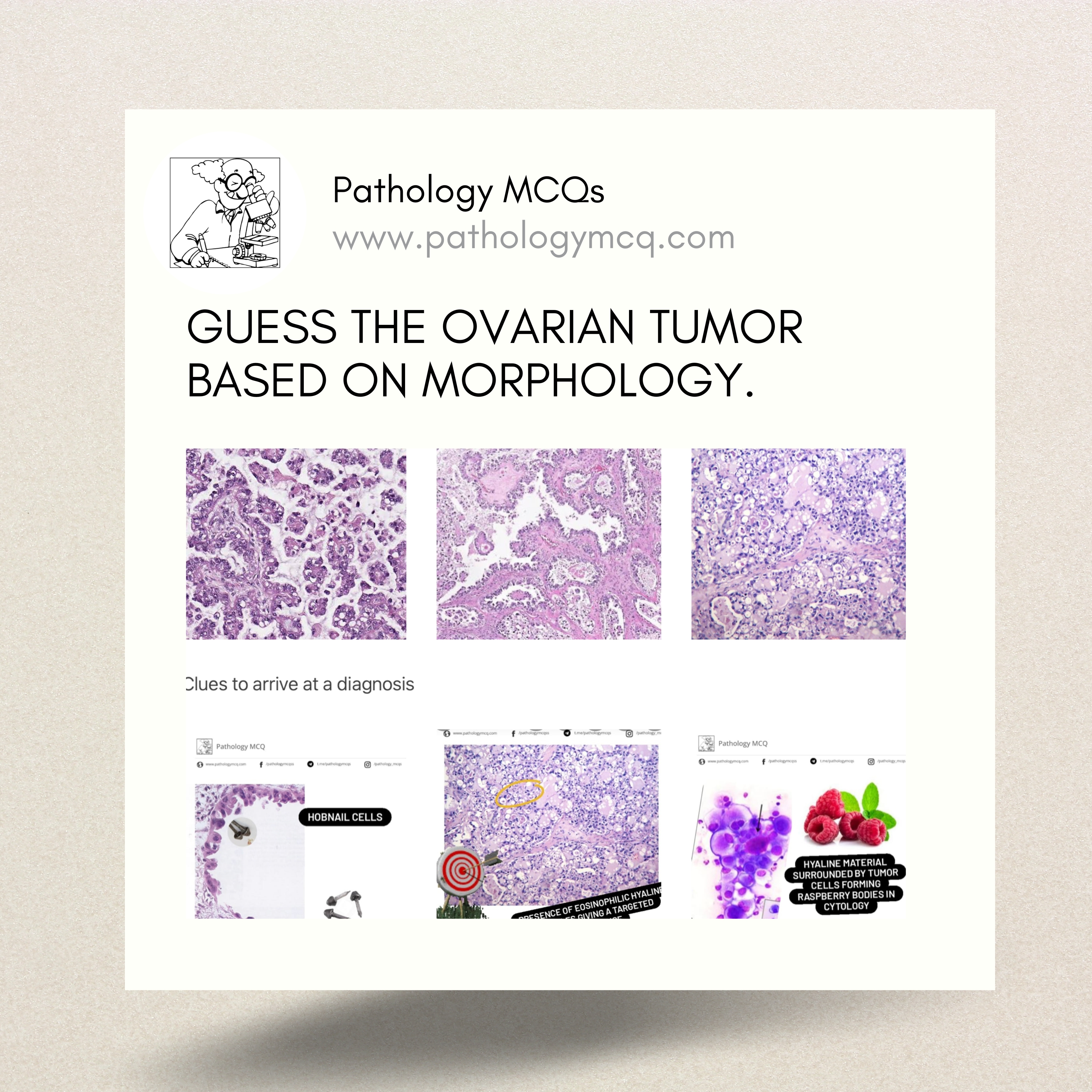 GUESS THE OVARIAN TUMOR BASED ON MORPHOLOGY.