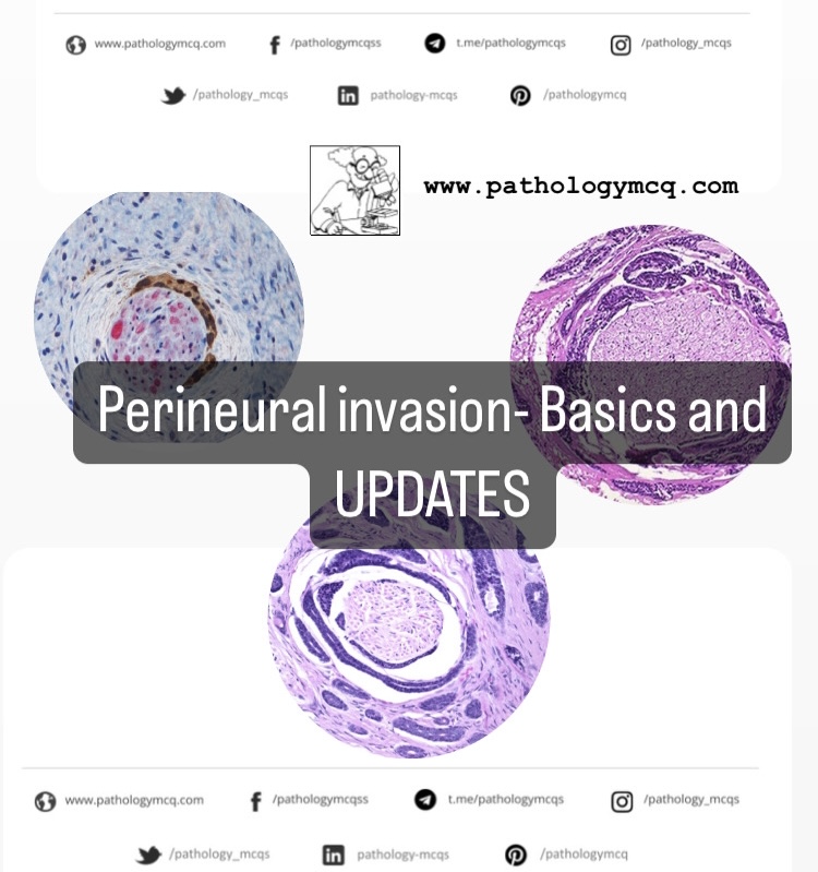 Perineural invasion- Basics and Updates
