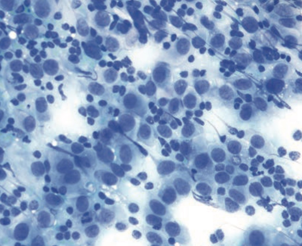 Pathological Test Pattern Breast pathology NEET-SS exam pattern test - PATHOLOGY MCQs