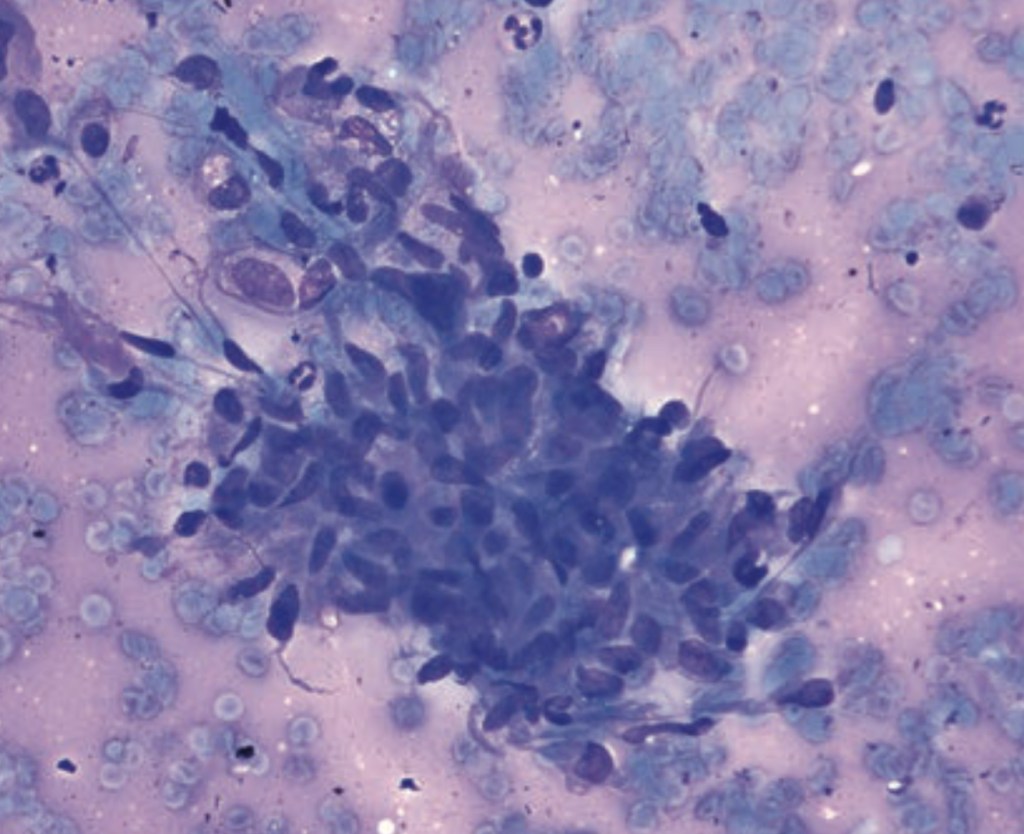 Pathological Test Pattern Breast pathology NEET-SS exam pattern test - PATHOLOGY MCQs