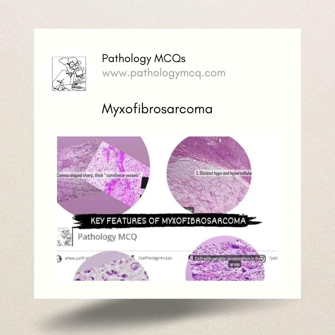 Myxofibrosarcoma: Histopathology, Immuno- histochemistry, and Differential Diagnosis