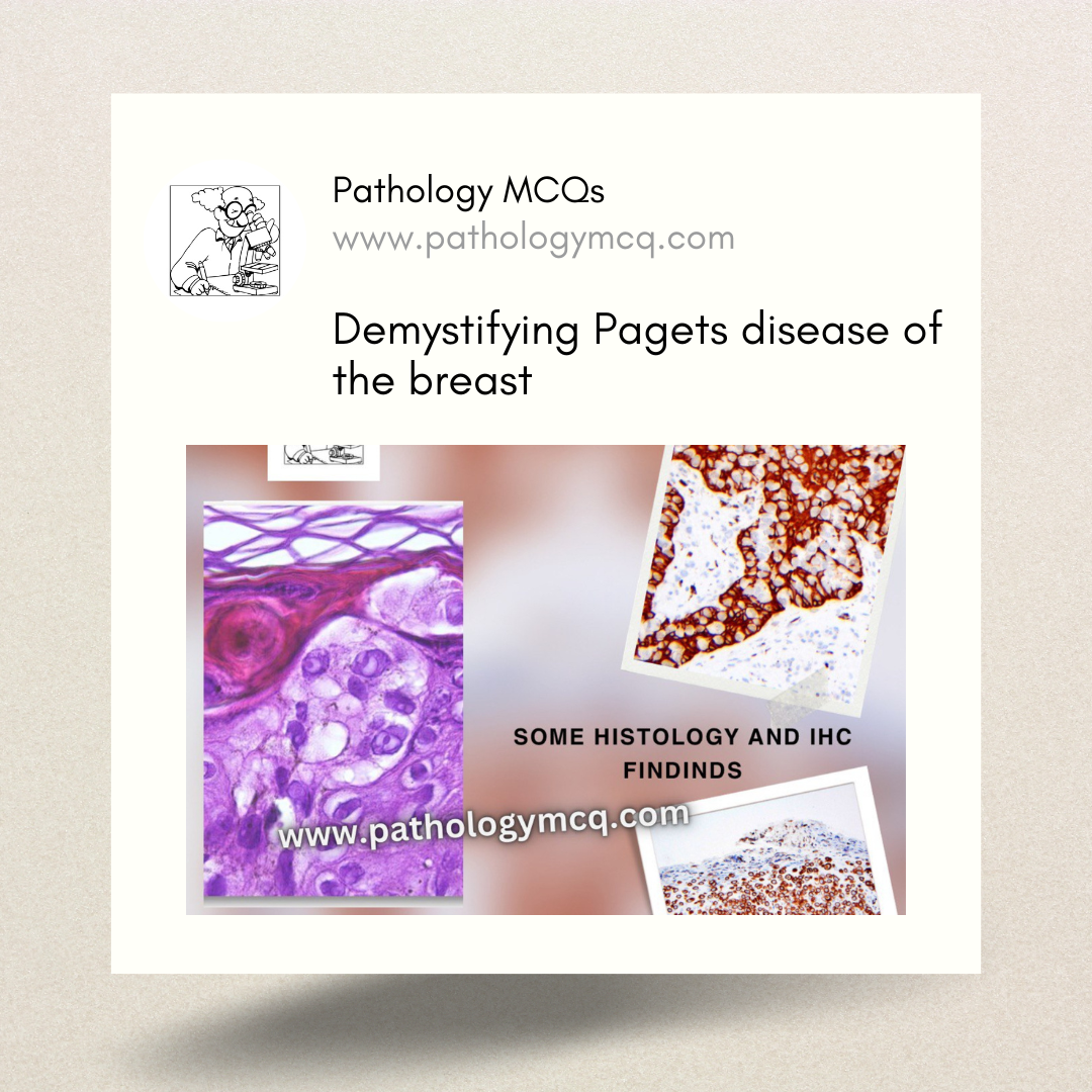 Paget’s Disease of Breast: Histology and Immuno- histochemistry