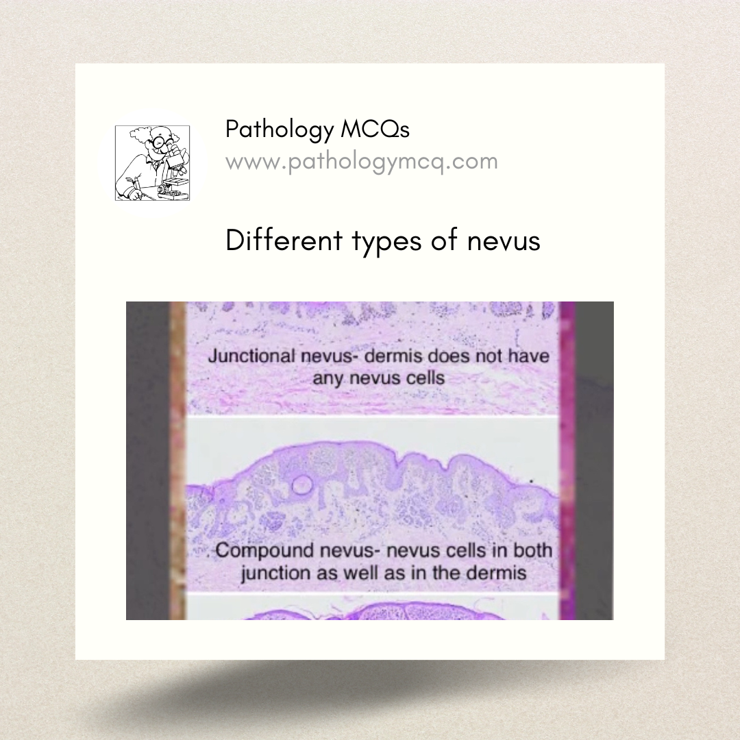 Histologic Variations of Nevus: Intradermal, Junctional, and Compound Types