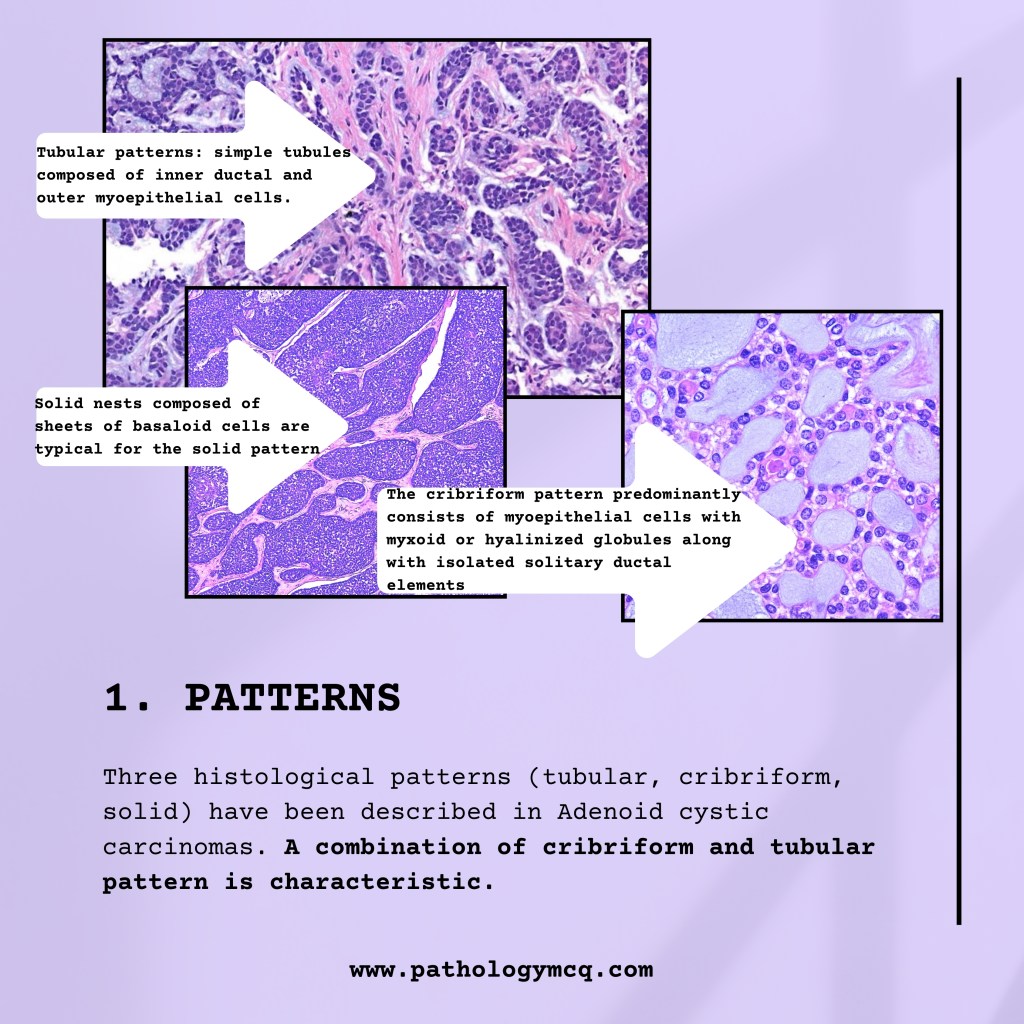 Key points in Adenoid cystic carcinoma (ACC) - PATHOLOGY MCQs