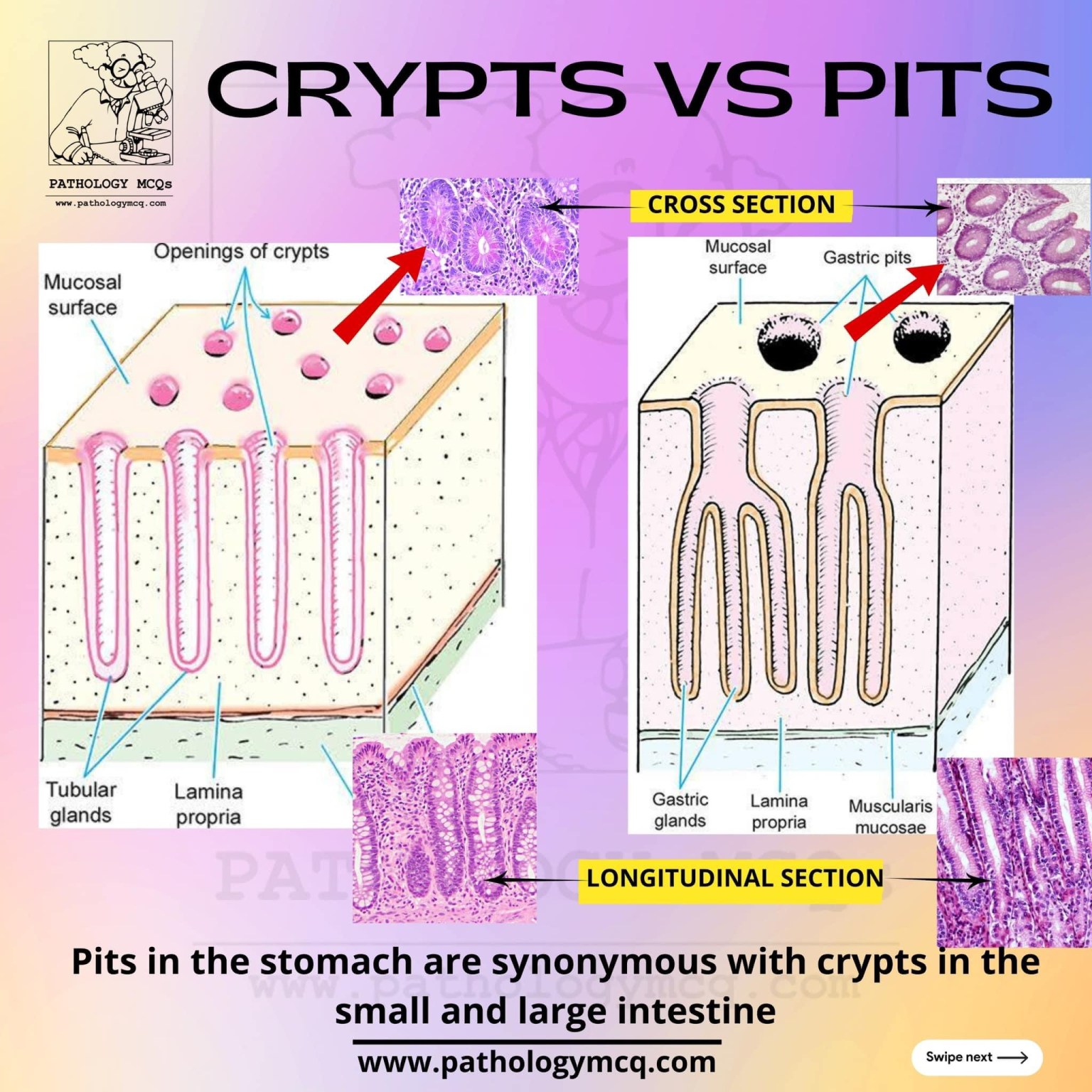 Pititis Chronic Active Gastritis: Histologic Features - PATHOLOGY MCQs