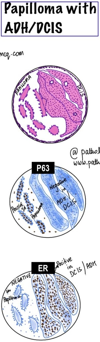 Understanding Papillary Breast Lesions: A Comprehensive Overview ...