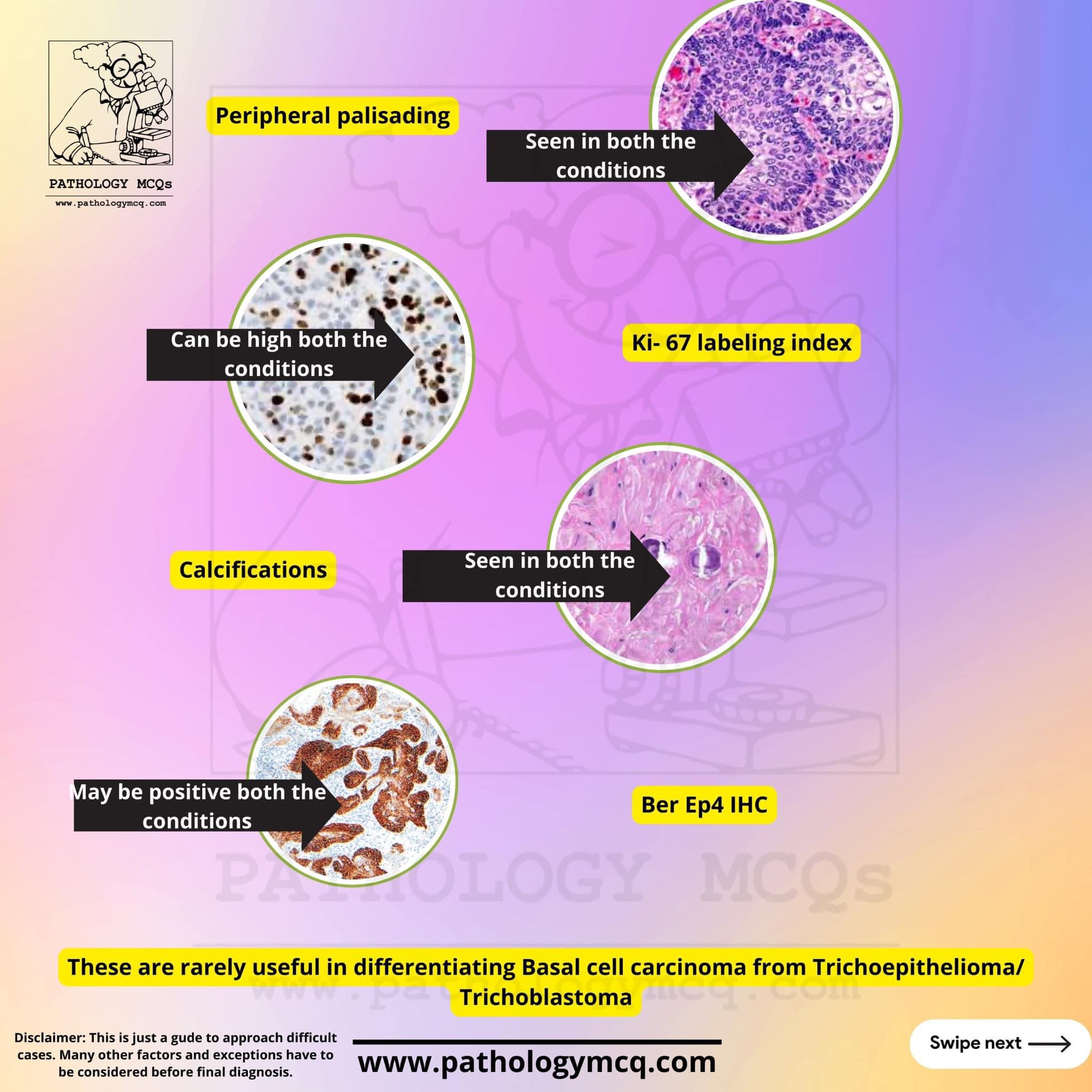 Distinguishing Basal Cell Carcinoma from Trichoepithelioma ...