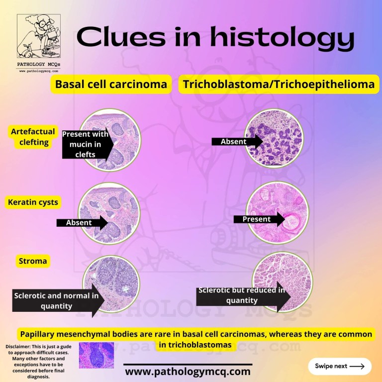 Distinguishing Basal Cell Carcinoma from Trichoepithelioma ...