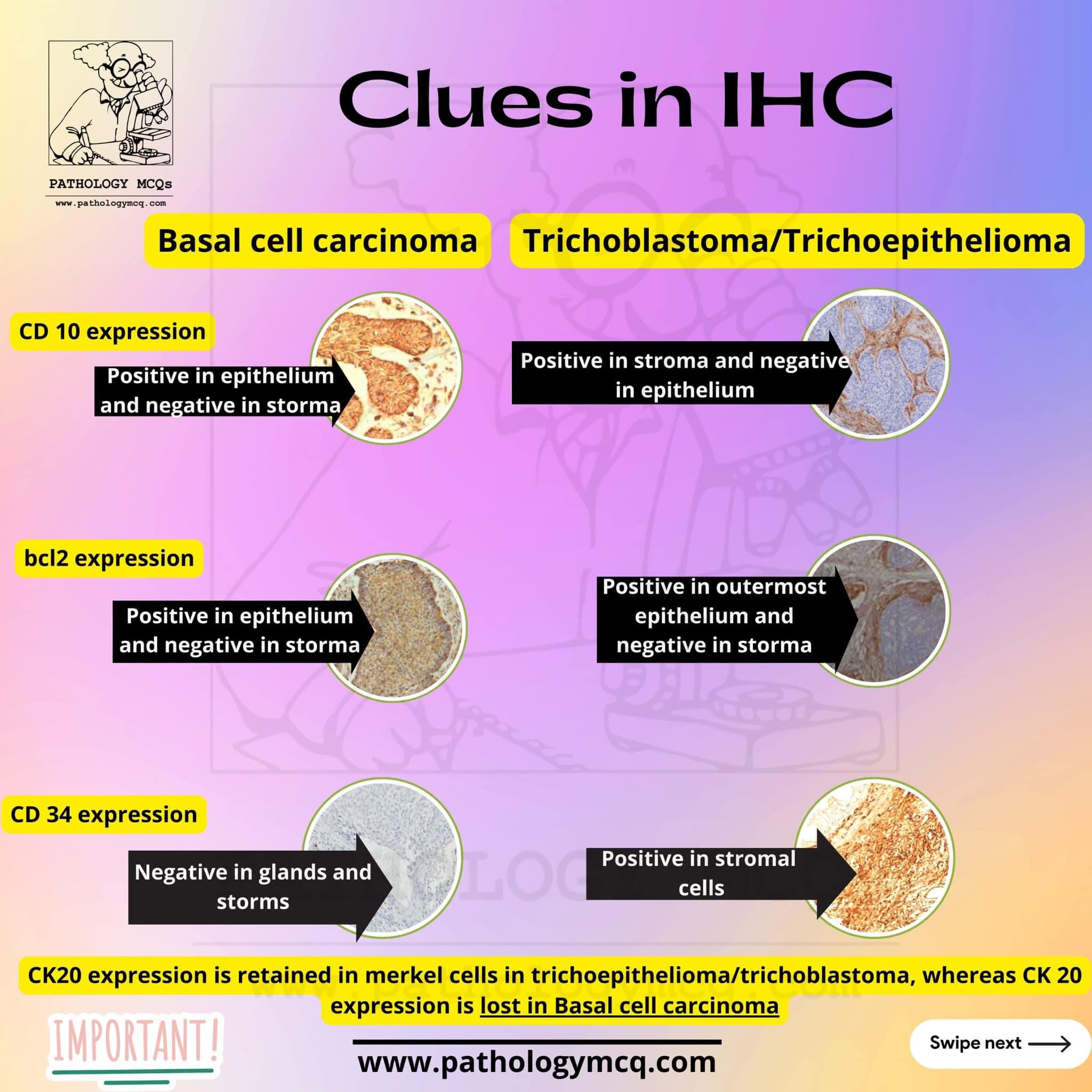 Distinguishing Basal Cell Carcinoma from Trichoepithelioma ...