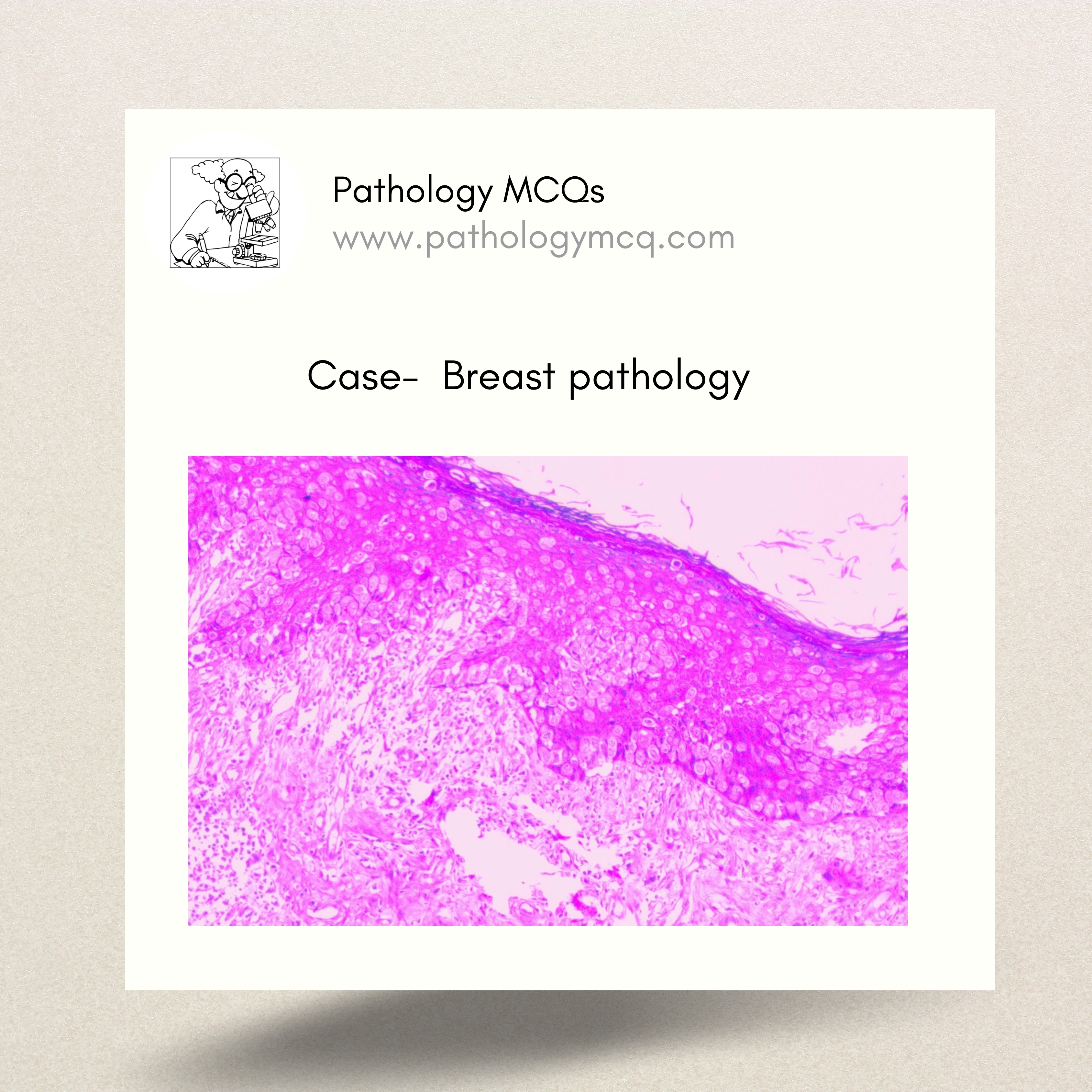Case: 53-year old female with eczematous change in the nipple-areolar region.