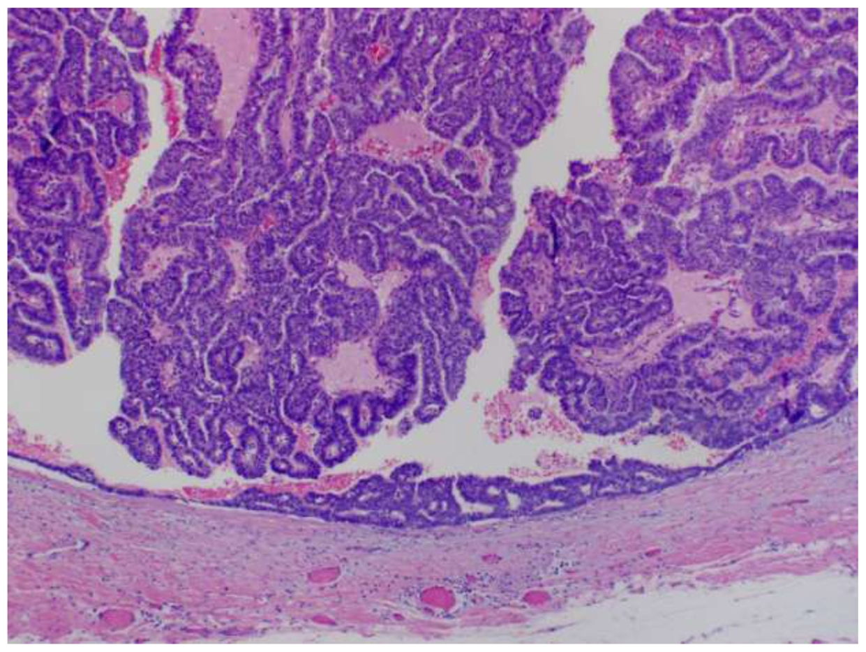 Papillary lesions of the breast - QUIZ - PATHOLOGY MCQs