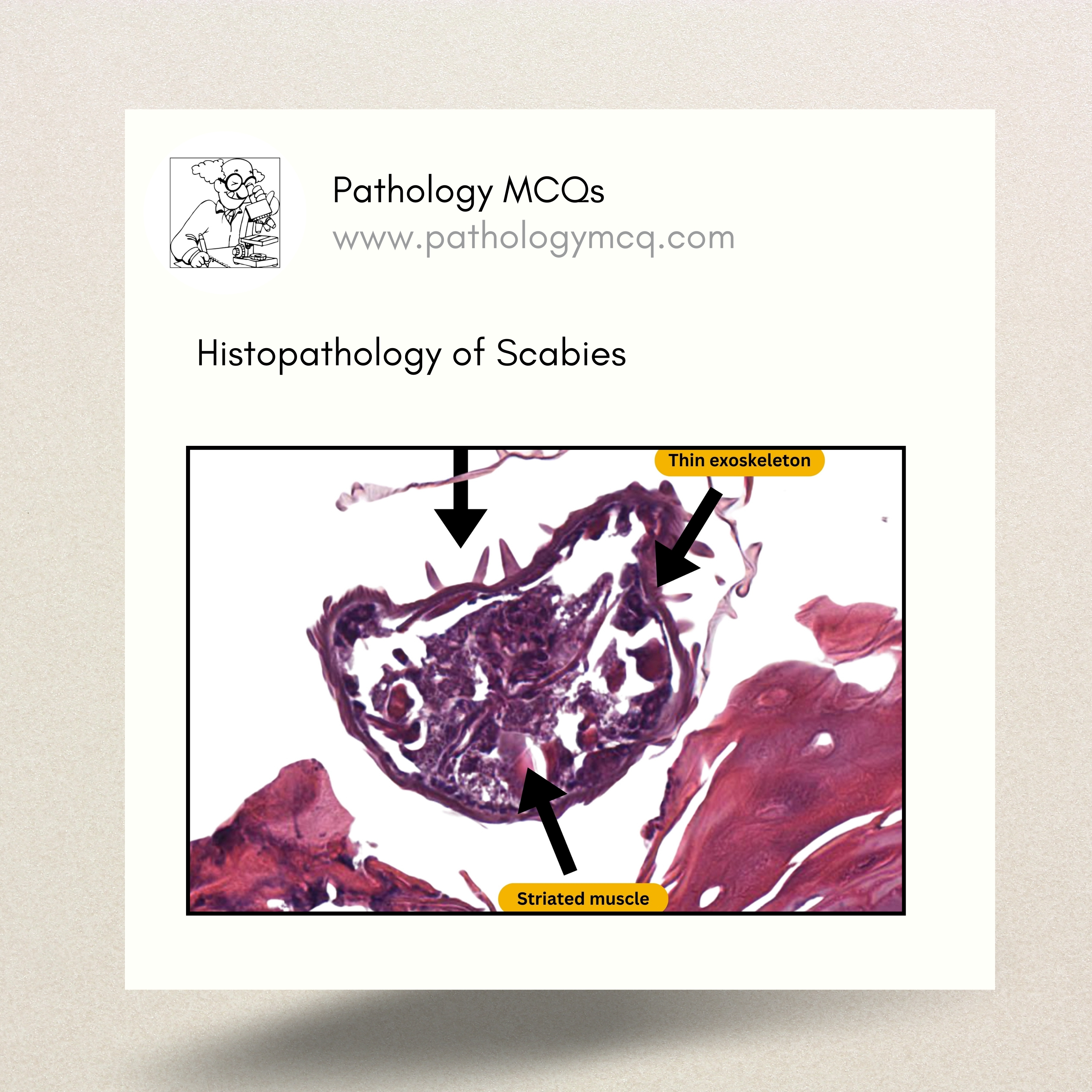 Histopathology of Scabies