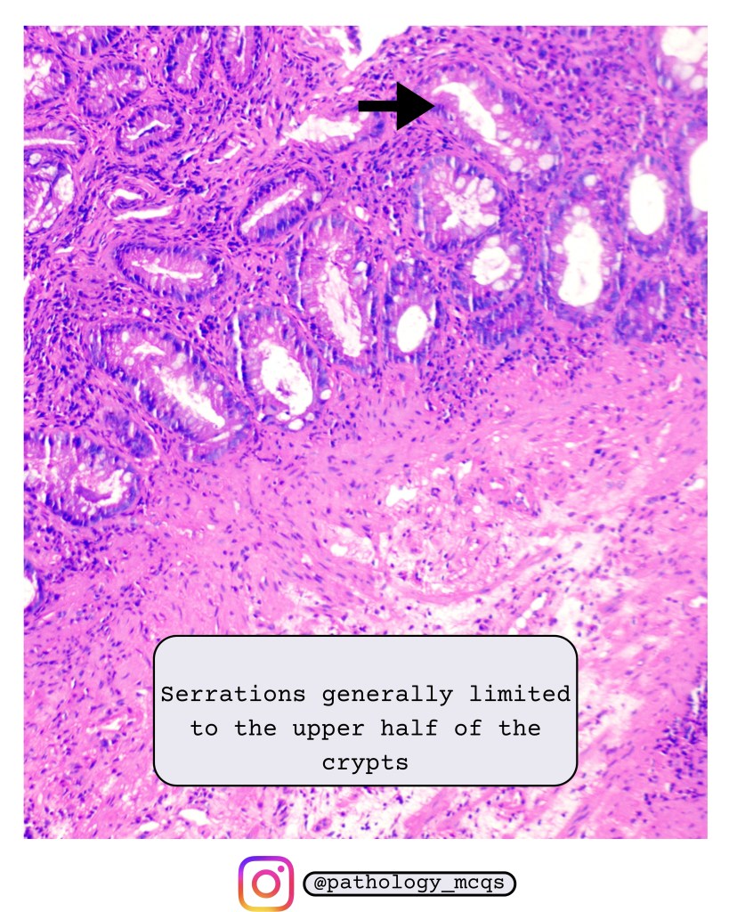 Defiant Polyp Hyperplastic Polyp Pathology: Histology, Diagnosis, MCQs & Differentiation