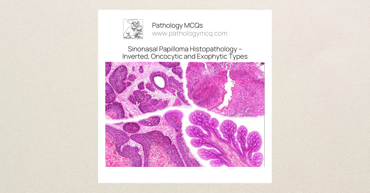 Sinonasal Papilloma Histopathology: Types, HPV Association & Diagnostic Criteria