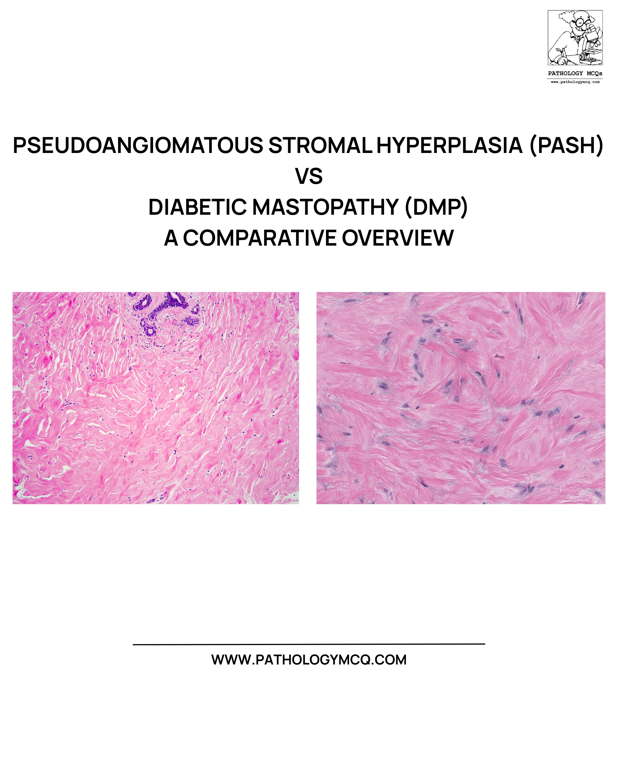Pash Pseudoangiomatous Stromal Hyperplasia vs Diabetic Mastopathy ...