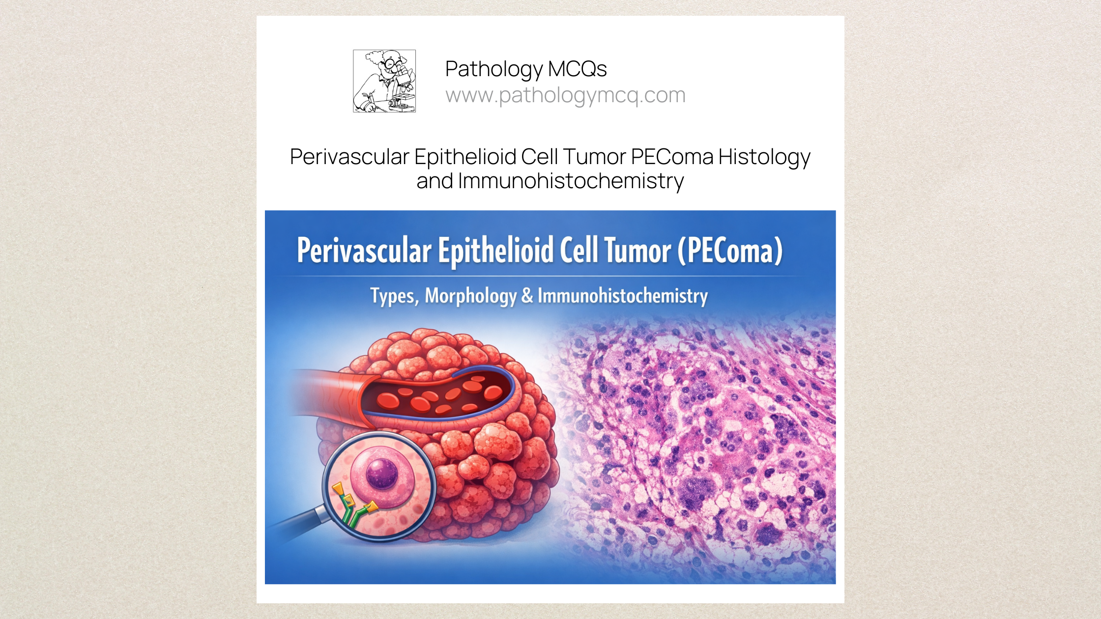 Perivascular Epithelioid Cell Tumor (PEComa) โ Types, Morphology and Immunohistochemistry