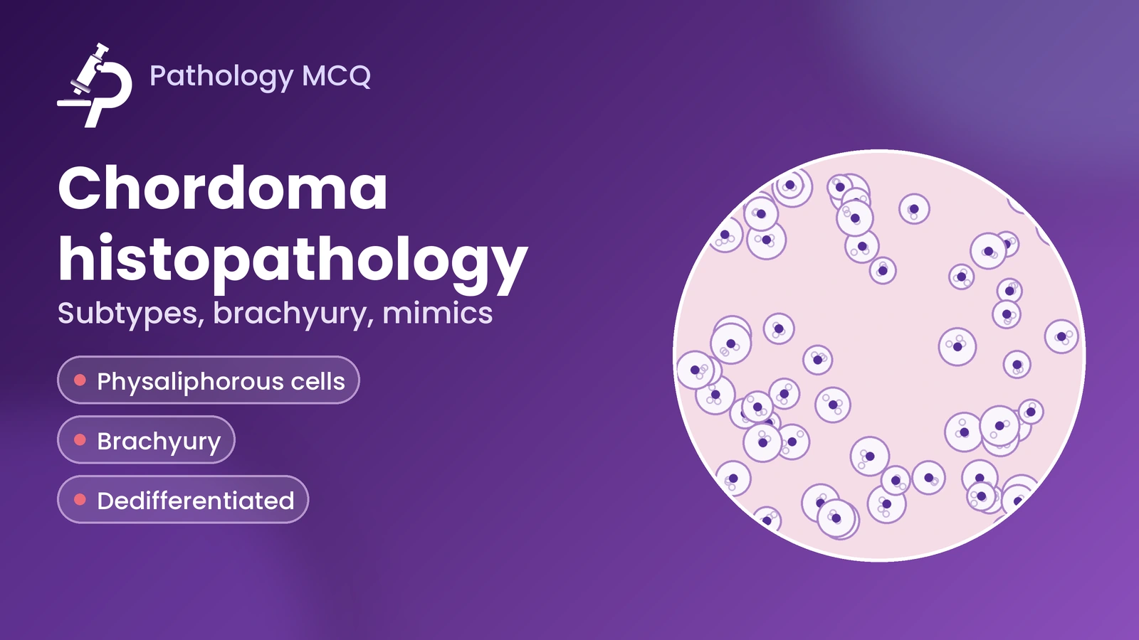 Chordoma Histopathology – Conventional, Poorly Differentiated and Dedifferentiated Types, Brachyury, Mimics and MCQs