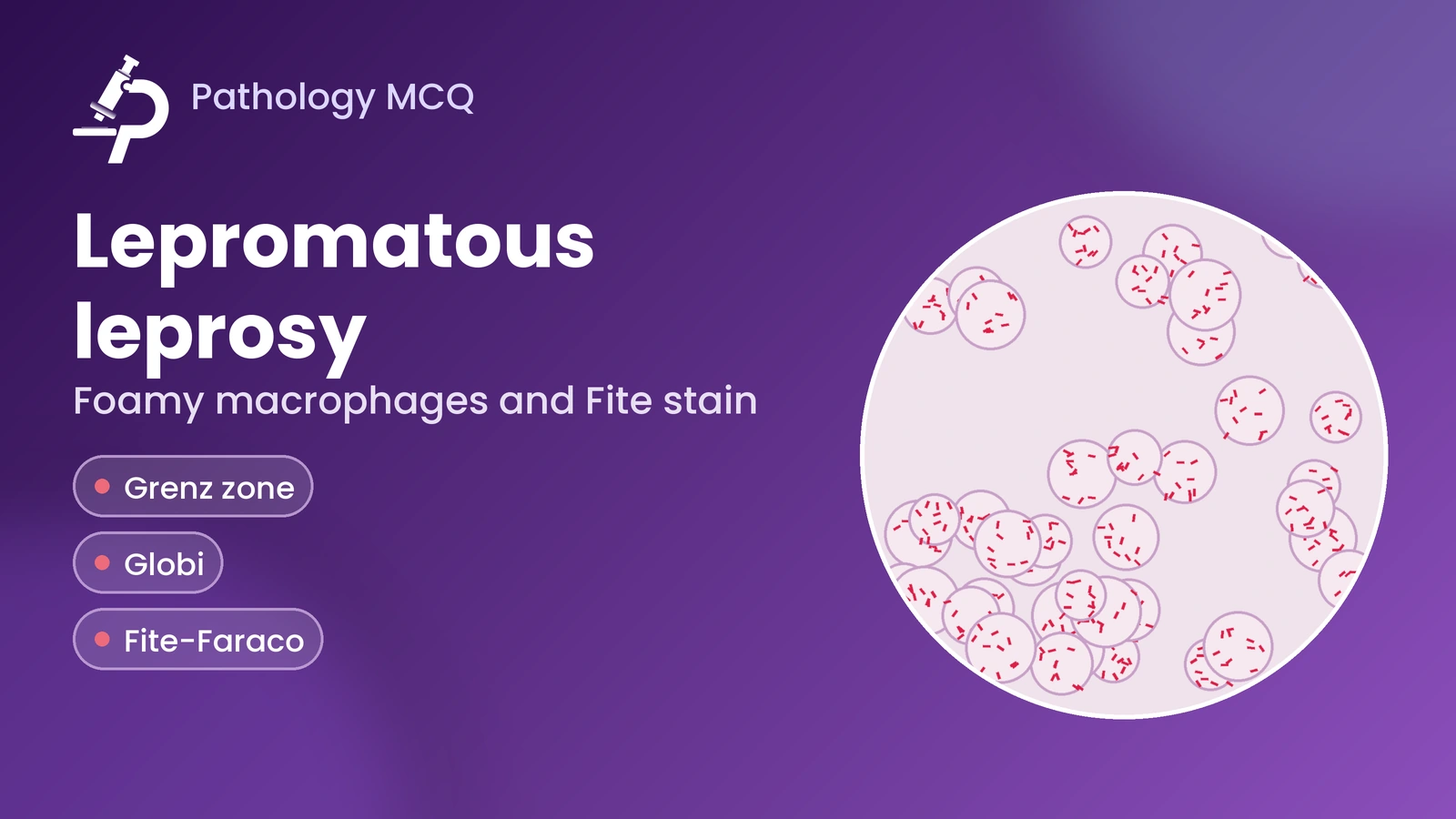 Lepromatous Leprosy – Histopathology, Diagnosis & MCQs