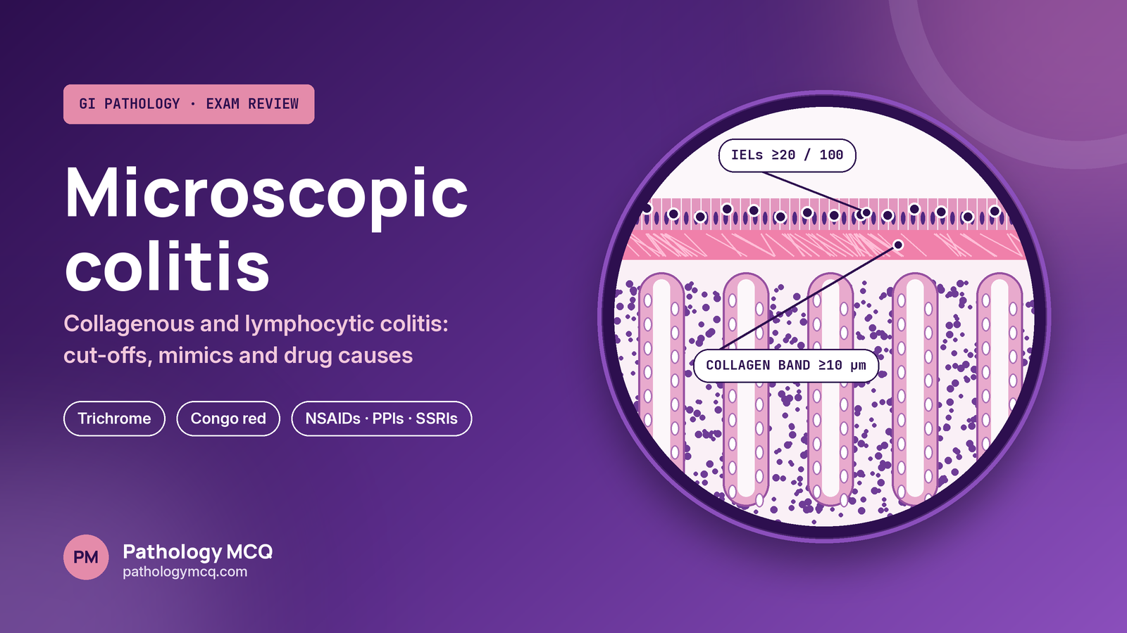 Microscopic Colitis: Collagenous and Lymphocytic Colitis Diagnosis – Histologic Cut-offs, Mimics, and Drug Causes