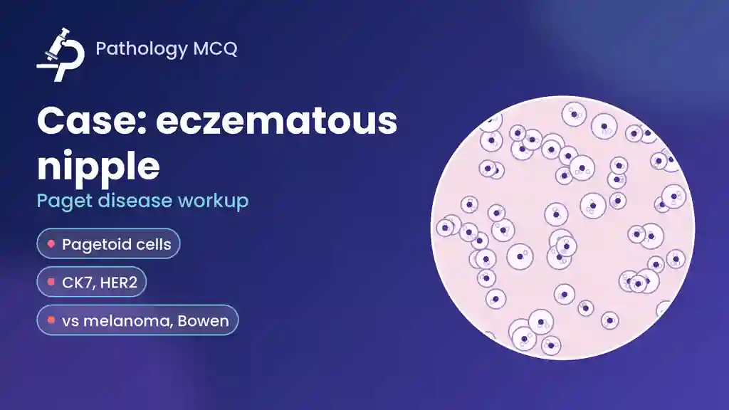 Case: 53-Year-Old Woman With an Eczematous Nipple – Paget Disease Workup, IHC and Case MCQs